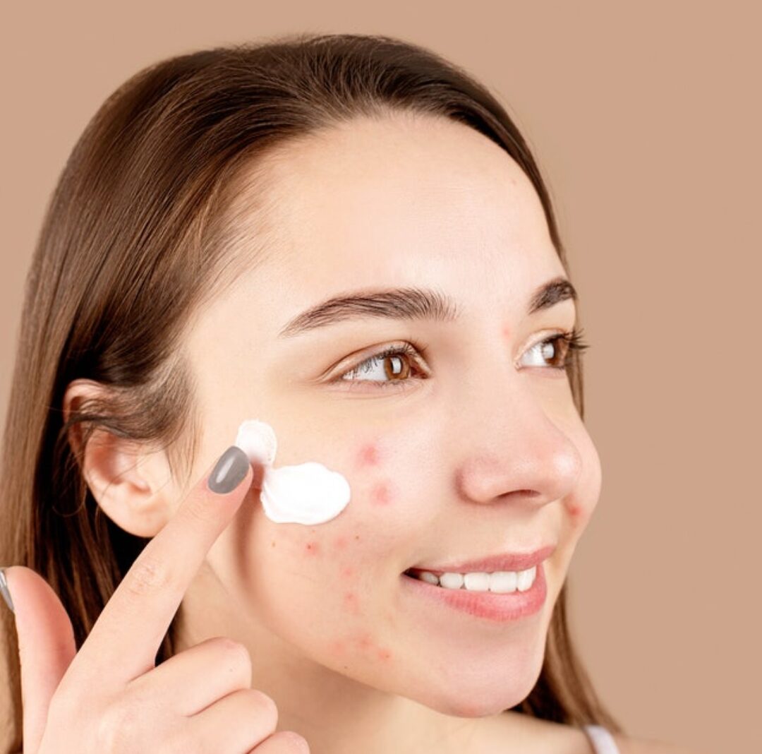 Can you get rid of acne and its scars? Find out here