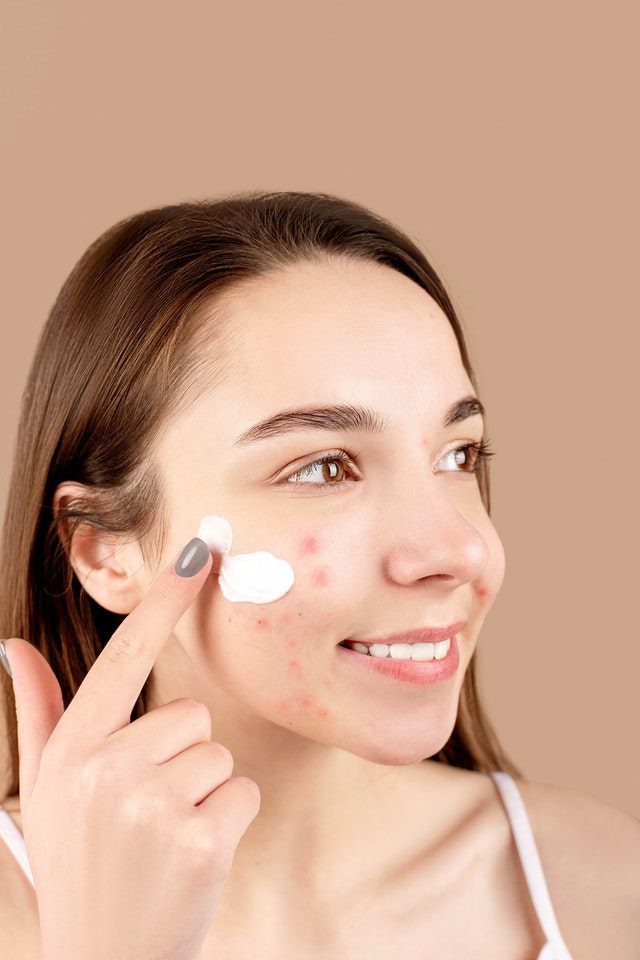 You are currently viewing Can you get rid of acne and its scars? Find out here